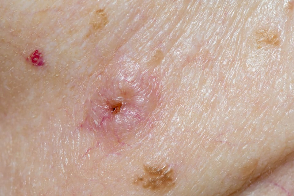 ¿Qué es el SARM?, piel, infección, bacterias, infecciones, SARM