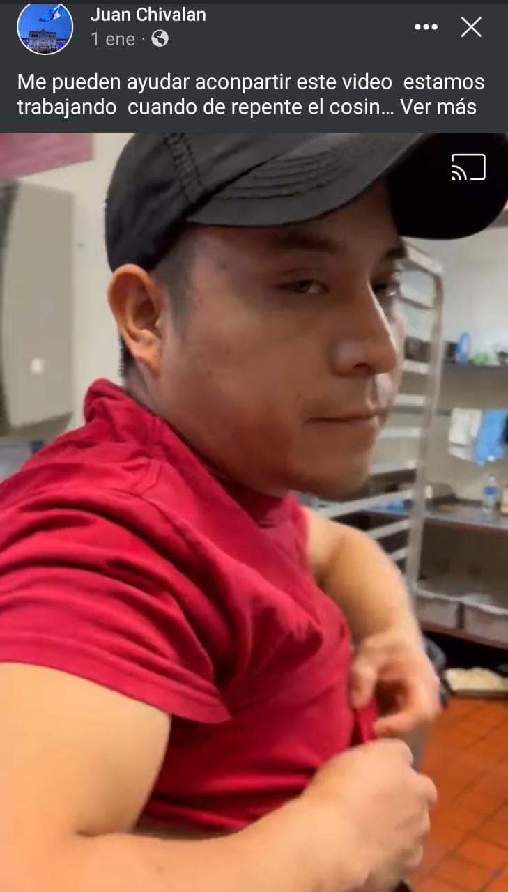 Hispano fue quemado en el trabajo por el cocinero con agua caliente