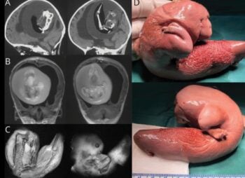 Encuentran feto vivo en la cabeza de una niña