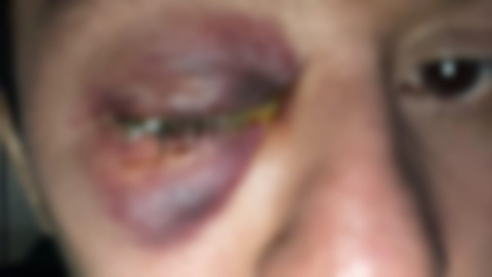 Óscar Mora, eye, sight, attack, help, USA