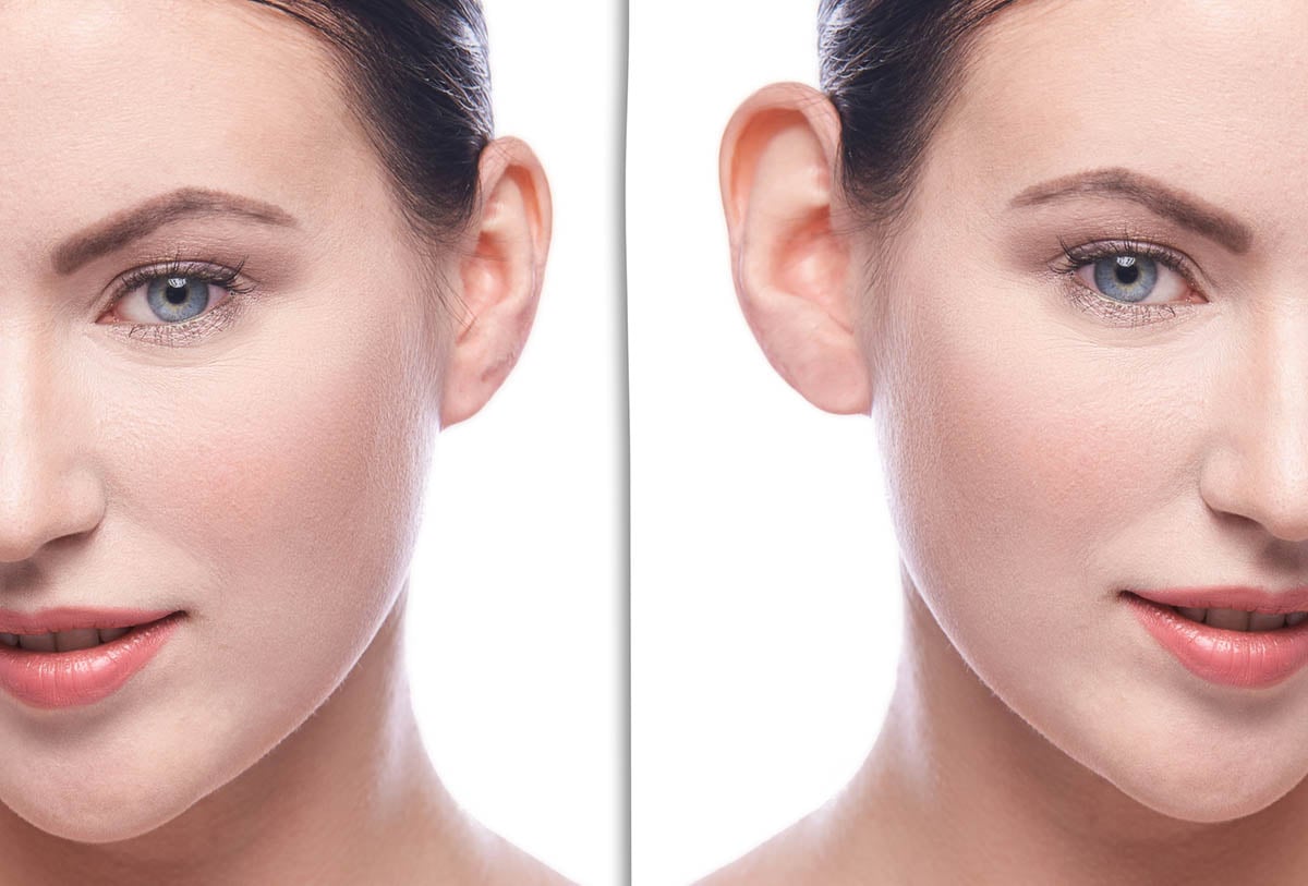 Understanding buccal fat removal: Is it right for you?