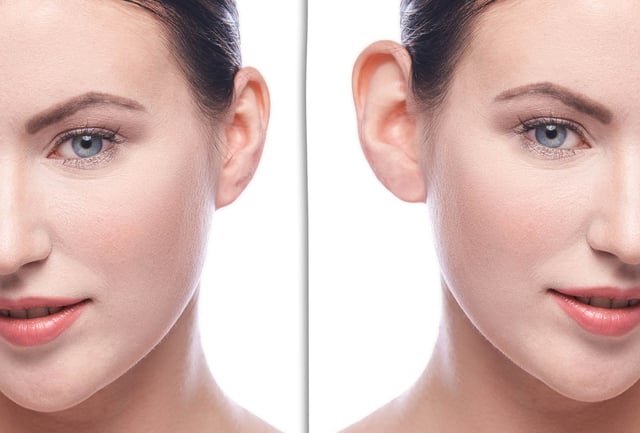 Understanding buccal fat removal: Is it right for you?