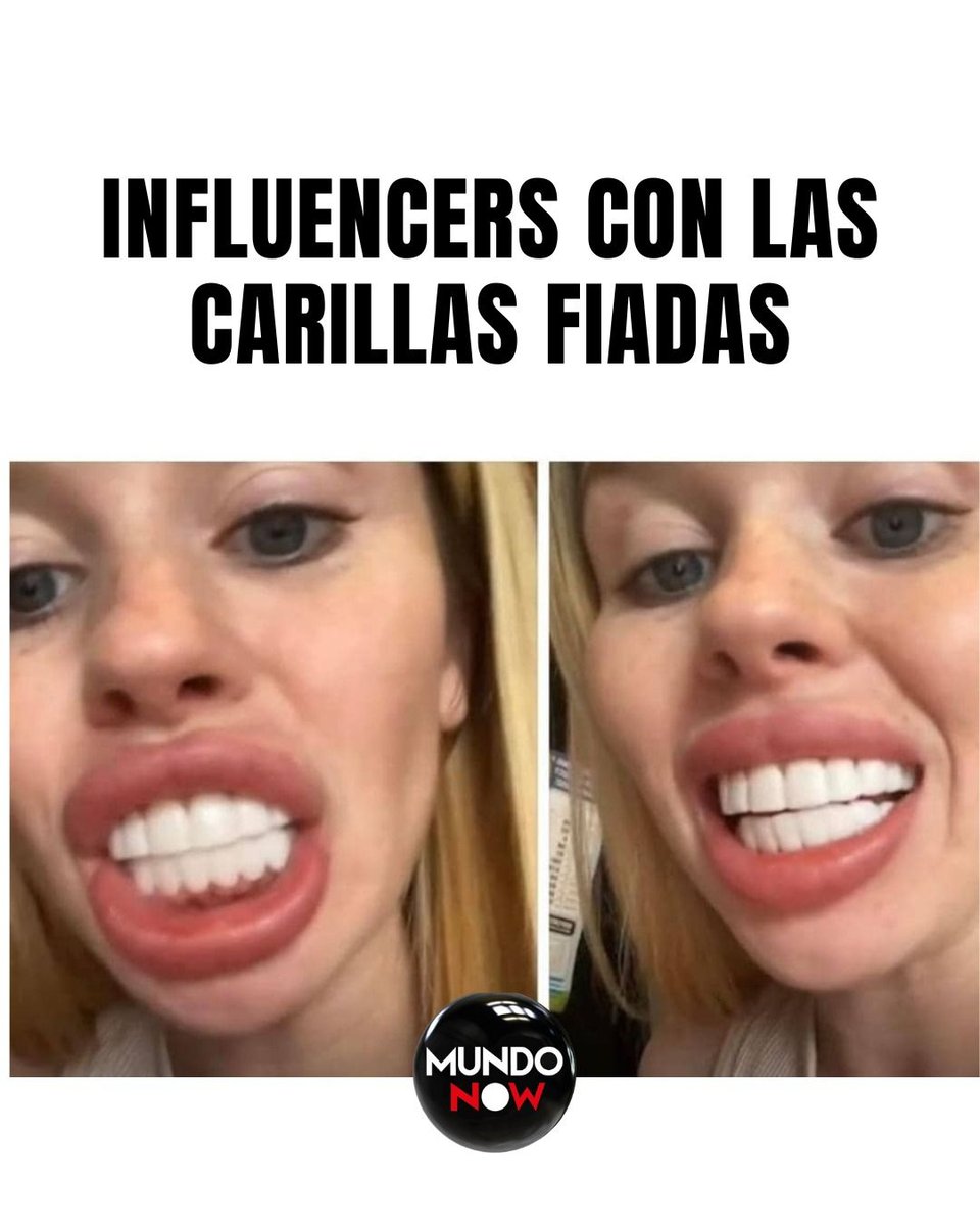 influencer, carillas, dientes, rubia, mujer