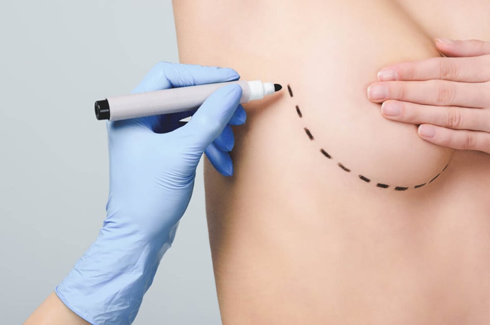 doctor, breast, surgery, trans, procedure
