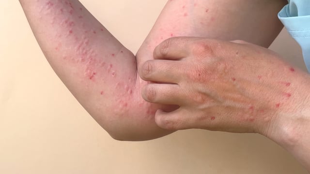 Confirman casos de tomate flu, enfermedad contagiosa para niños