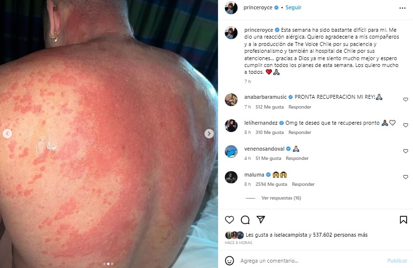suffered an allergic reaction