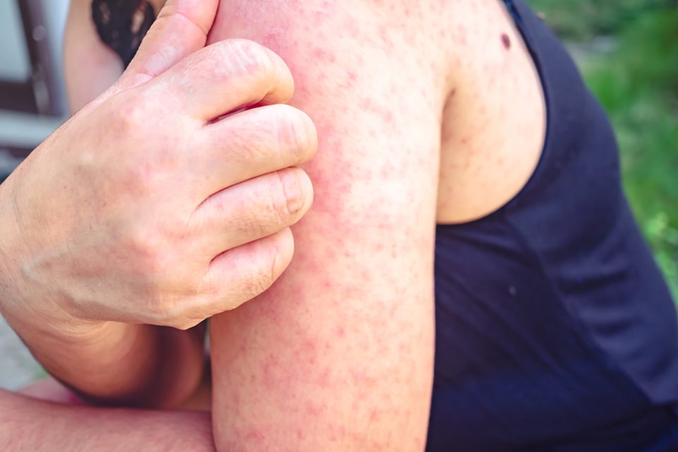 Kawasaki disease