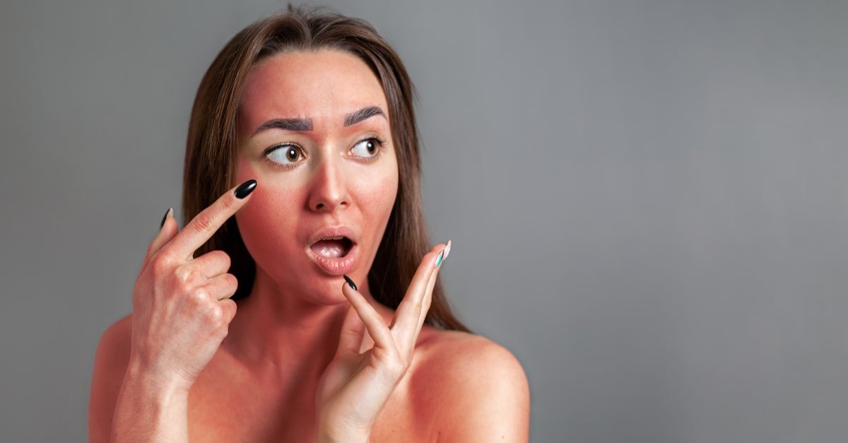 Burn Notice: Natural Sunburn Treatment Tips