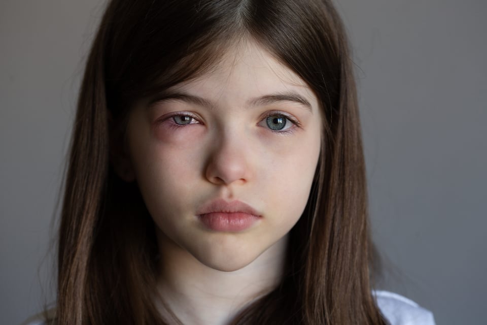 pink eye