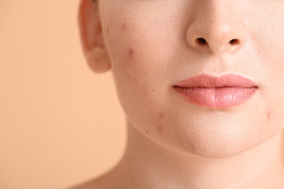 Salicylic acid, beta-hydroxy acid, acne, skincare, woman