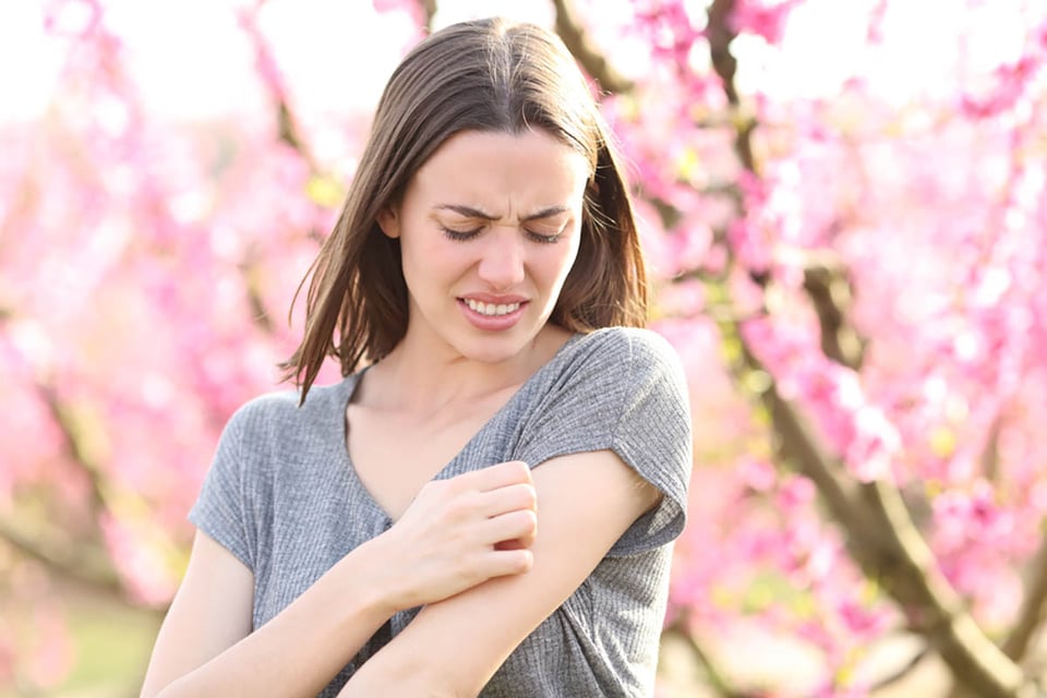 Quick relief: Effective home remedies for insect bites