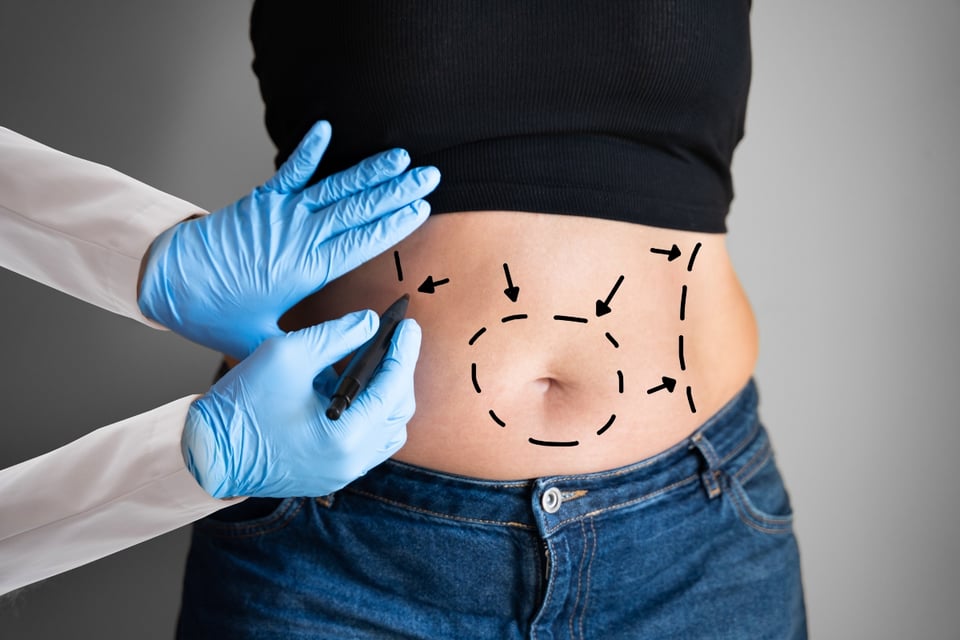 Venezuelan mom dies after getting liposuction at a shopping center
