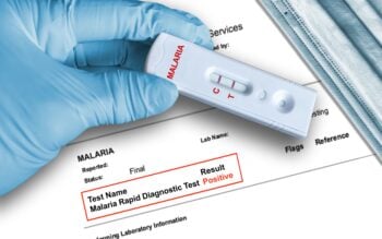 REPORTAN CASOS DE MALARIA EN FLORIDA