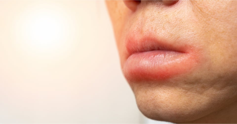 Labios hinchados con dolor