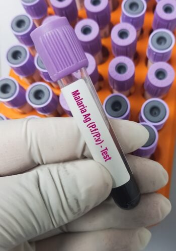 Alerta sanitaria malaria Florida: ¿Una emergencia en Estados Unidos?