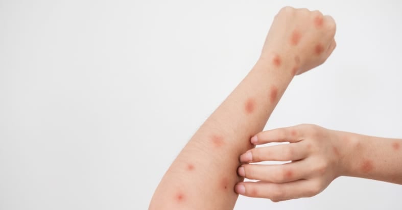 New symptoms of monkeypox include rectal pain and penis swelling