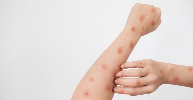 Dolor de ano e hinchazón de pene, nuevos síntomas de la viruela del mono