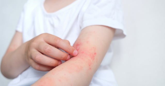 Allergies in children: 4 common culprits