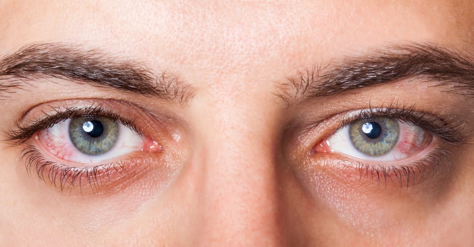eye infection