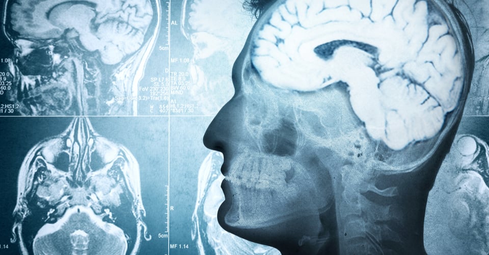 Síntomas del aneurisma cerebral: 12 señales para acudir a la sala de emergencias de inmediato