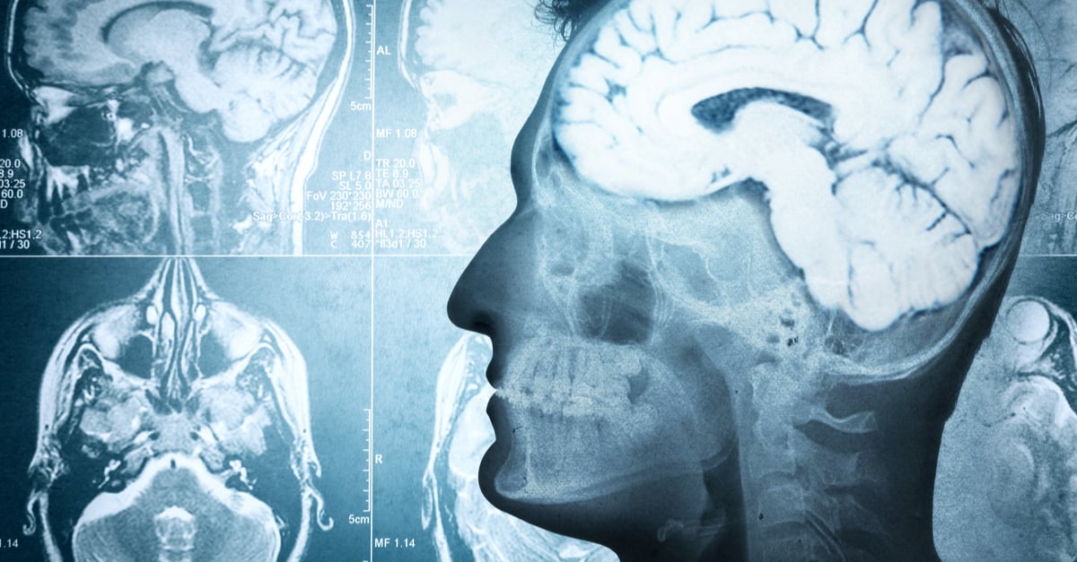 Síntomas del aneurisma cerebral: 12 señales para acudir a la sala de emergencias de inmediato