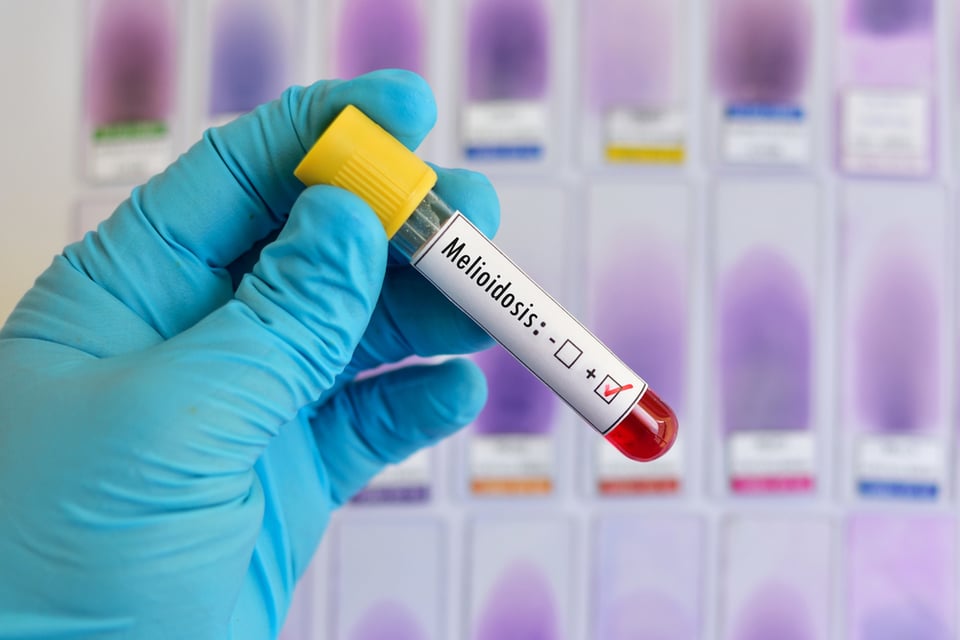 ¿Es curable la melioidosis?