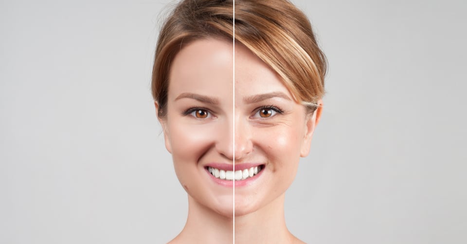 ¿Aplicarme botox hoy evitará las arrugas en el futuro?
