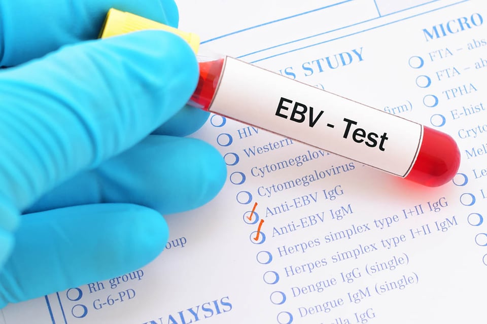 Epstein-Barr, EBV, virus, infection, illness, test