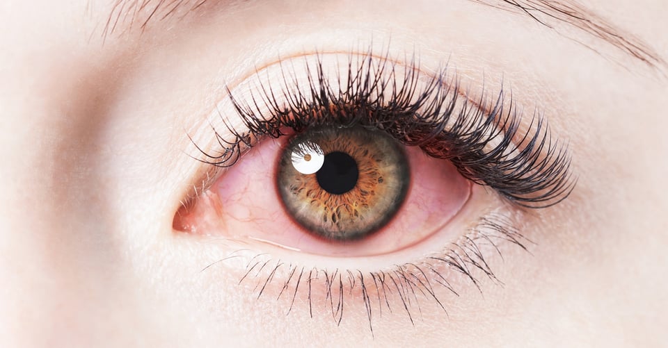 ¿Cuándo hay que preocuparse por un ‘ojo rojo’?