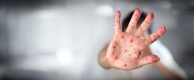 sarampión, BROTE, DC, ALERTA, SANITARIA