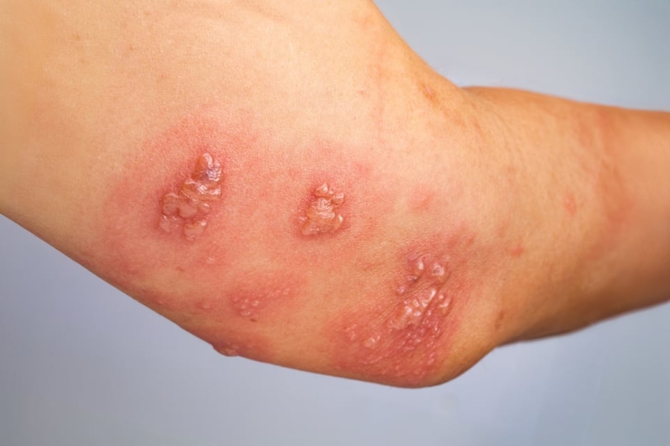 Culebrilla o herpes zóster puede aparecer después de los 50 años