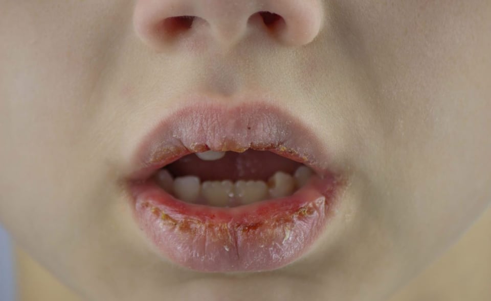 labios, agrietados, frio, quemados