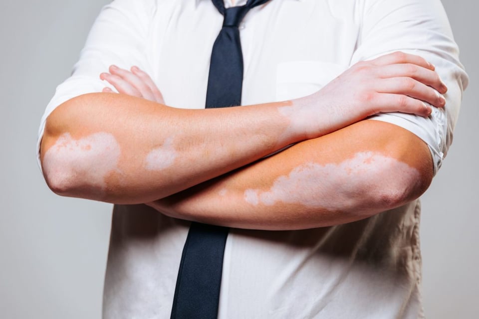 vitiligo, causas, sintomas