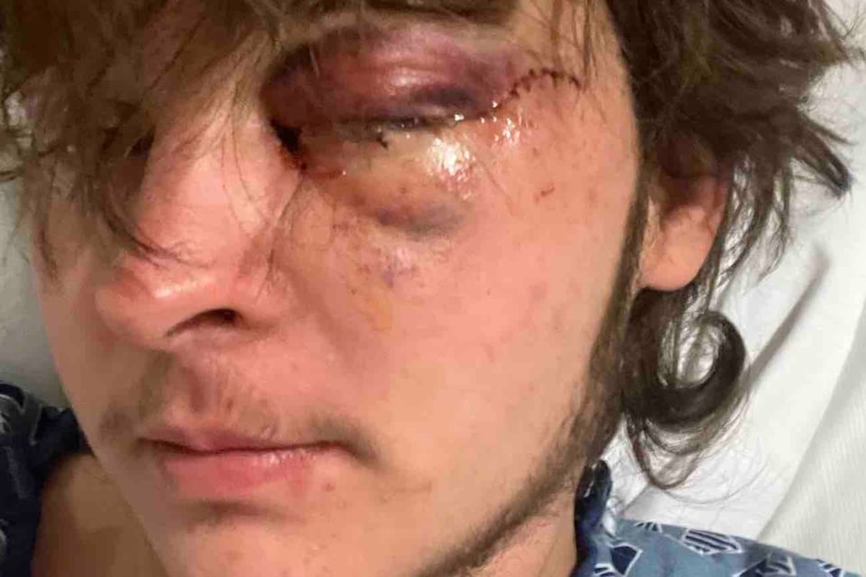 Joven pierde un ojo, Protesta contra ICE, Uso de fuerza MundoNOW