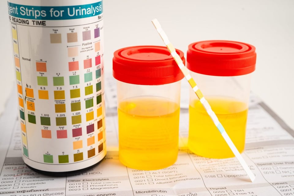 insuficiencia, renal, rinones, salud, bienestar, enfermedad