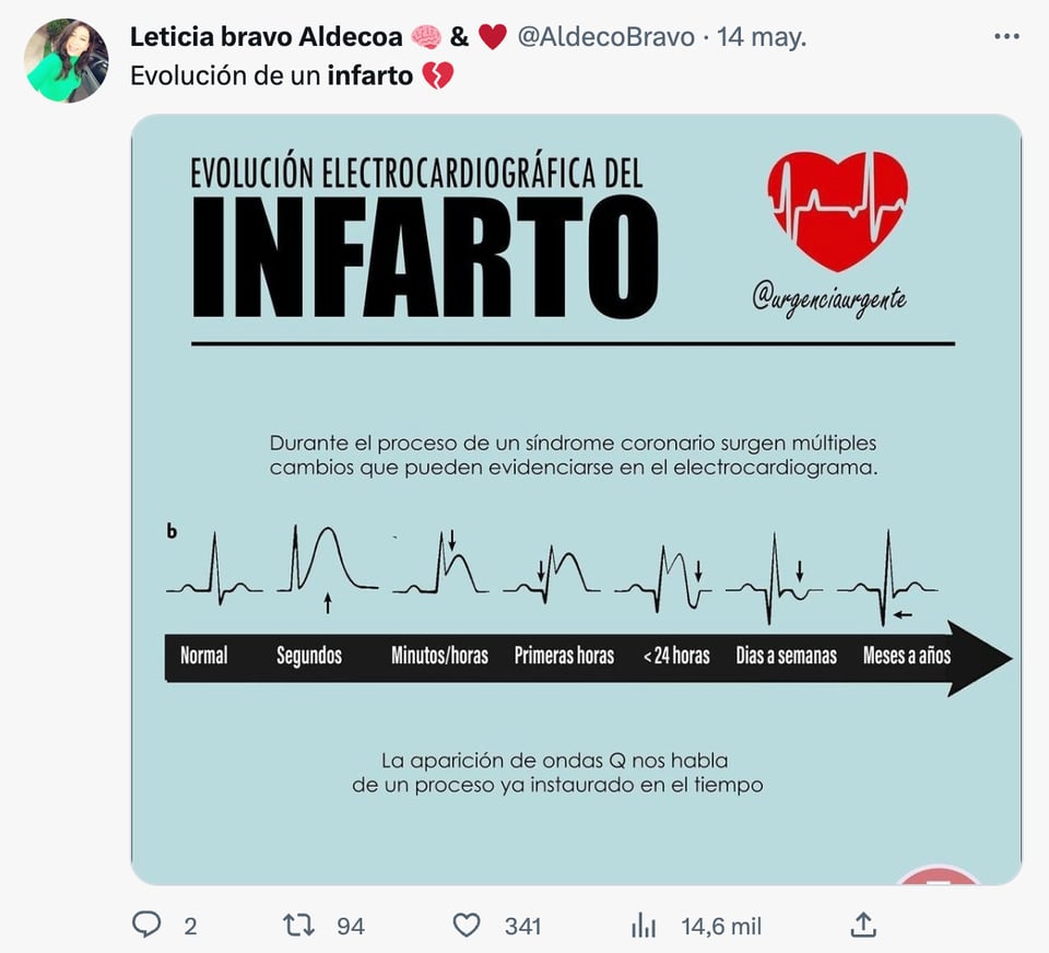 Causas del infarto agudo de miocardio