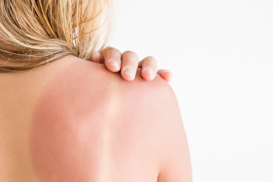 sol, daños por el sol, quemaduras, cáncer piel, MundoNow