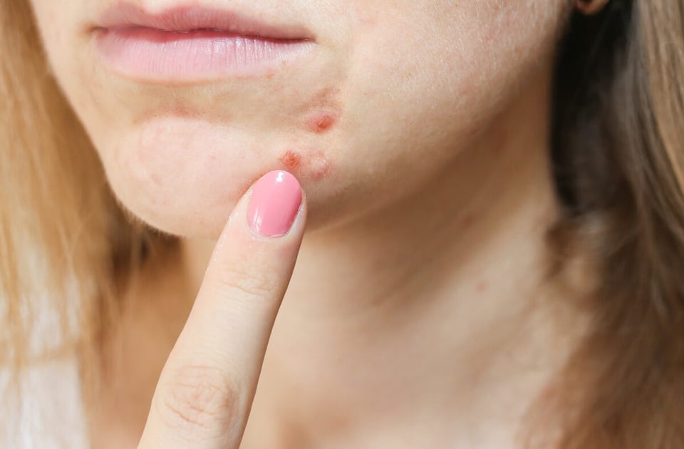 skin blemishes, Aquaphor