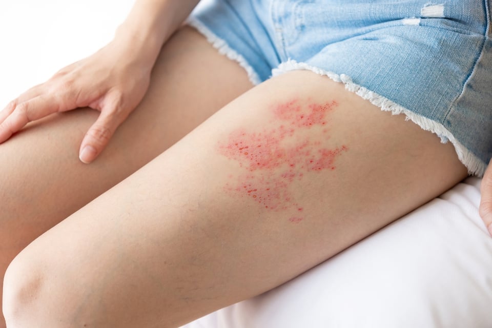 shingles Romina Marcos, red spots, mental health, disease, MundoNOW