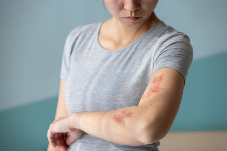 symptoms, causes, viral infection, rashes, MundoNOW, what is shingles