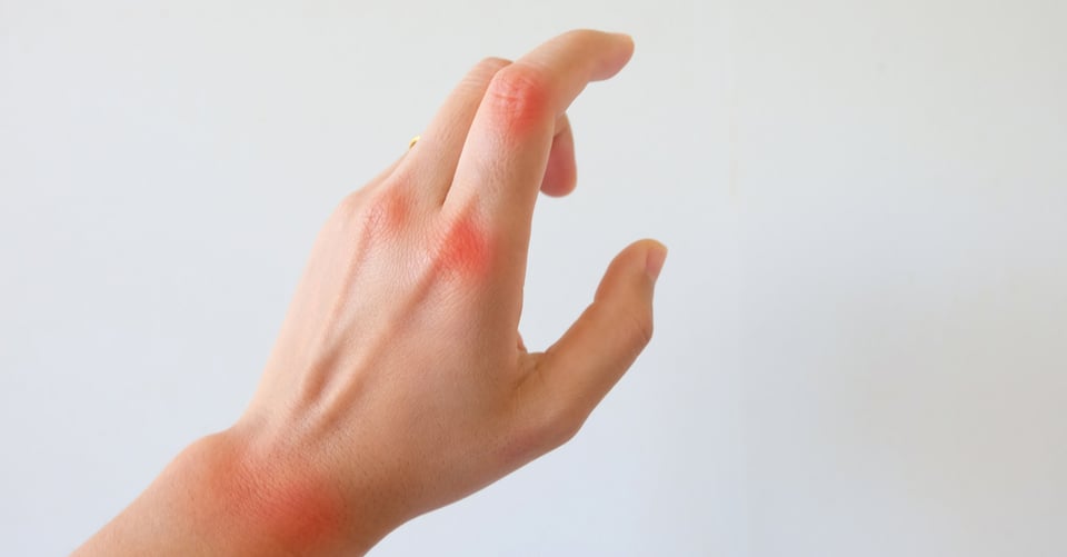 Una mano con manchas rojas como idea de artritis
